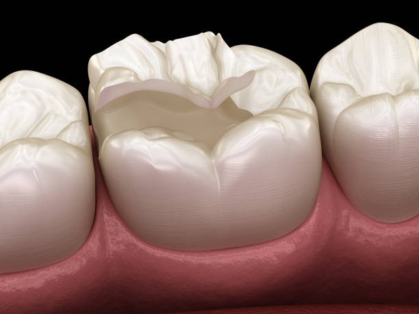 istock Inlay ceramic crown fixation over tooth. Medically accurate 3D illustration of human teeth treatment 1149710048