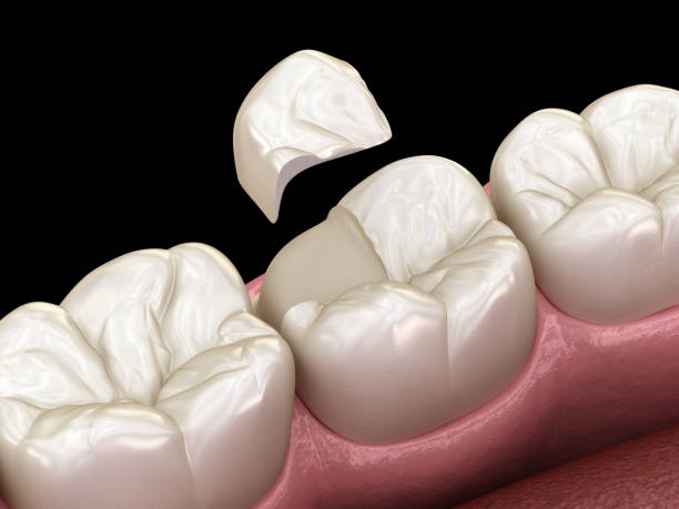 istock Onlay ceramic crown fixation over tooth. Medically accurate 3D illustration of human teeth treatment 1149710081
