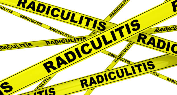 istock Radiculitis. Yellow warning tapes 1149860407