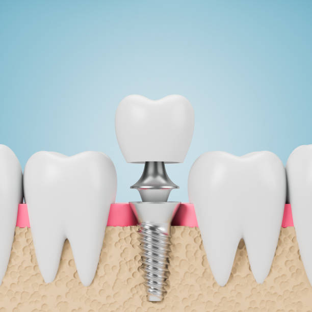 dents avec la vis d’implant, fond bleu - artificial metal healthcare and medicine technology photos et images de collection