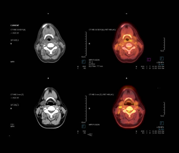 pet ct scan imagem de pescoço em comparação de plano axial tomografia computadorizada e pet ct para detectar recidiva do câncer no câncer de tireóide paciente. - computed - fotografias e filmes do acervo