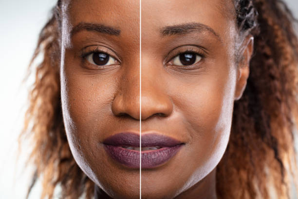 frau vor und nach kosmetischer prozedur - microdermabrasion stock-fotos und bilder
