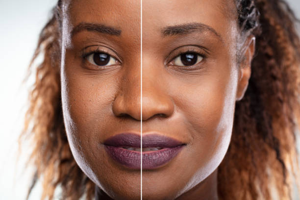 istock Woman's Face Before And After Cosmetic Procedure 1150345620