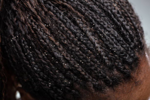 istock Dandruff In Woman's Hair 1150345638