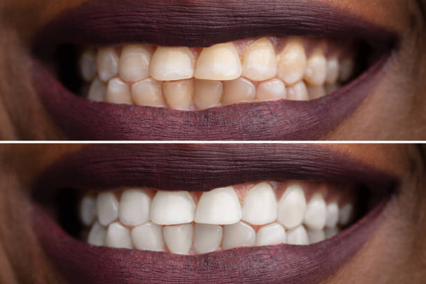 istock Woman's Teeth Before And After Whitening 1150345644