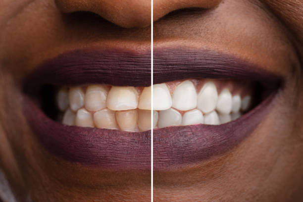 istock Woman's Teeth Before And After Whitening 1150346167