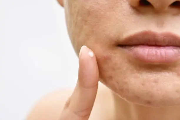 Photo of Acne and face skin problem, Woman applying acne cream medication, Topical pimple gel drug treatment.