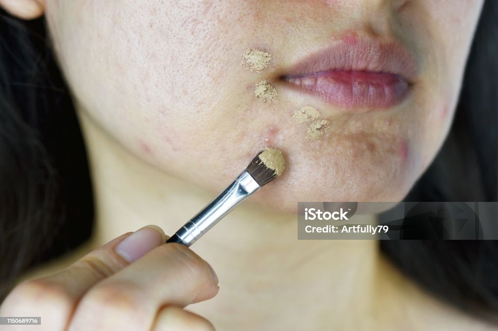 Cosméticos Acné Mujer Asiática Aplicando Maquillaje Corrector Para Ocultar  El Acné Problema De La Piel Facial Granos Corrigiendo La Cobertura Foto de  stock y más banco de imágenes de Maquillaje - iStock