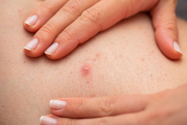istock Folliculitis on female leg - squeezing 1150707002