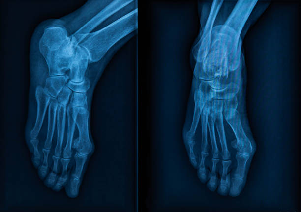 발 x 선 필름 - data side view close up horizontal 뉴스 사진 이미지