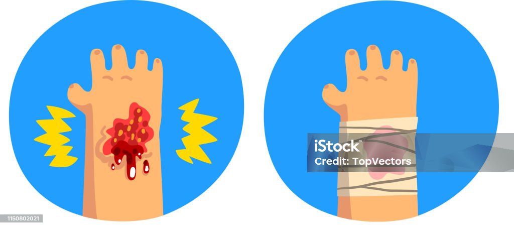 Scrape Hand Wounded Hand Physical Injury First Aid And Treatment Vector ...