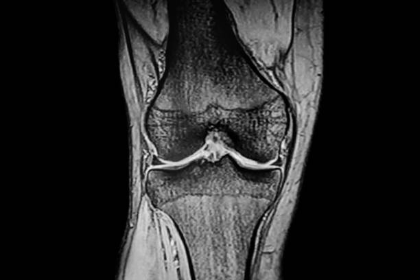 ct 스캔 무릎 관절 - x ray human knee orthopedic equipment human bone 뉴스 사진 이미지