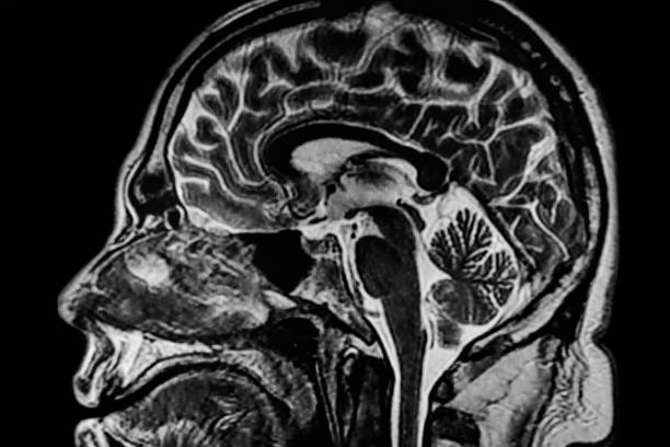 MRI image brain MRI image brain brain tumour photos stock pictures, royalty-free photos & images