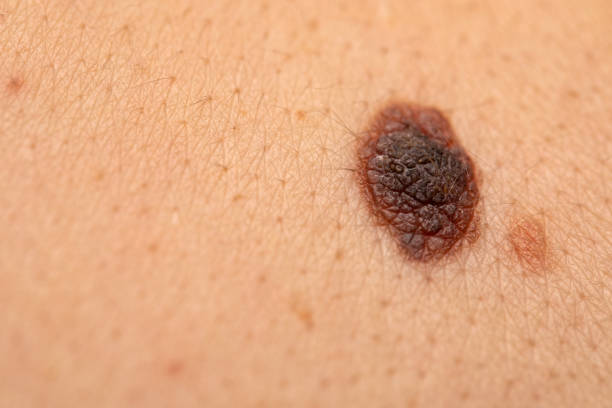 istock Dangerous nevus on skin - melanoma 1150885453