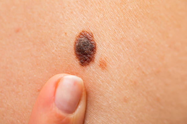 gefährlicher nevus auf der haut-melanom - raised skin stock-fotos und bilder