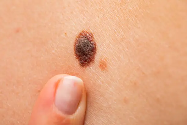 Photo of Dangerous nevus on skin - melanoma