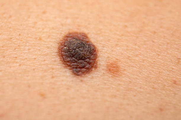 istock Dangerous nevus on skin - melanoma 1150885475