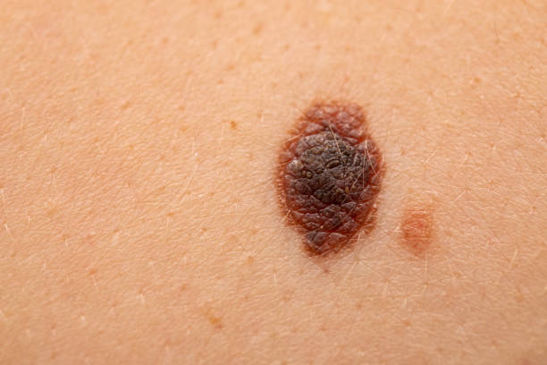 Dangerous nevus on skin - melanoma stock photo