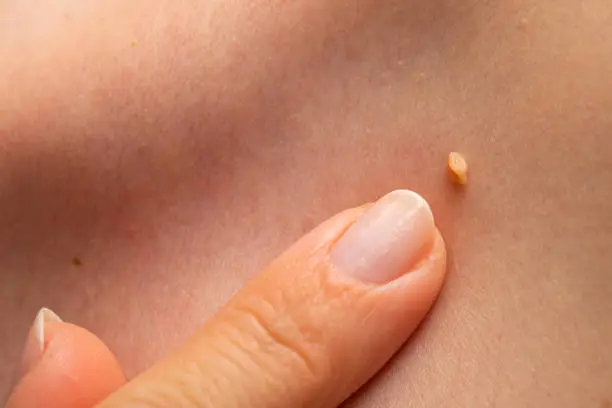 Close up picture of papilloma on human skin, finger pointing at the wart