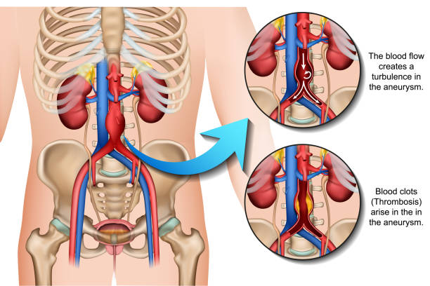 illustrazioni stock, clip art, cartoni animati e icone di tendenza di illustrazione vettoriale medica 3d aneurisma addominale isolata su sfondo bianco - aorta