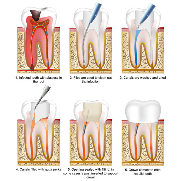 Root canal treatment medical vector illustration on white background with description Root canal treatment medical vector illustration on white background with description eps 10 Canal stock illustrations