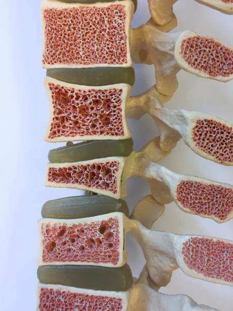 Anatomical model of Cross-section of spinal column and vertebral bodies showing different stages of osteoporosis Anatomical model of Cross-section of spinal column and vertebral bodies showing different stages of osteoporosis anatomist photos stock pictures, royalty-free photos & images