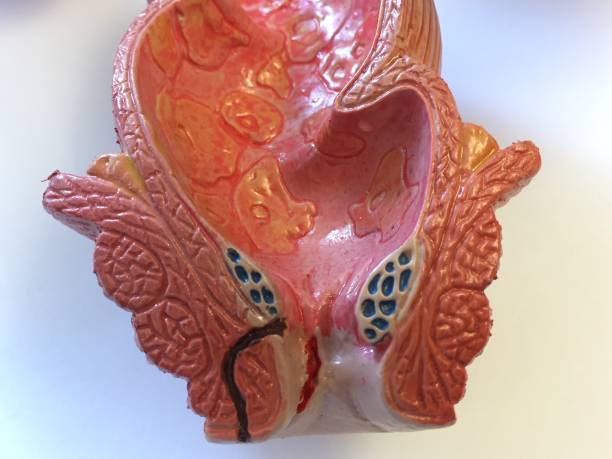 Anatomical model of rectum, anus and colon showing hemorrhoids, fistulas and mucous membrane as seen in chronic inflammatory bowel disease Anatomical model of rectum, anus and colon showing hemorrhoids, fistulas and mucous membrane as seen in chronic inflammatory bowel disease anus stock pictures, royalty-free photos & images