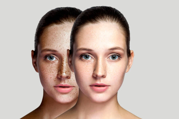 крупным планом до и после портрета красивой брюнетки женщины после лазерного лечения удаления веснушек на лице смотрит в камеру. макияж ил� - freckle стоковые фото и изображения