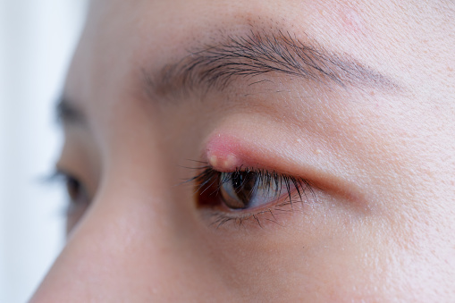 Close up of Asian young woman with brown eye with stye infection. Eyelid abscess, hordeolum in medical health, disease and treatment concept.
