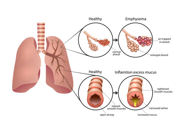 ilustraciones, imágenes clip art, dibujos animados e iconos de stock de ilustración de la enfermedad pulmonar obstructiva crónica - neumonía