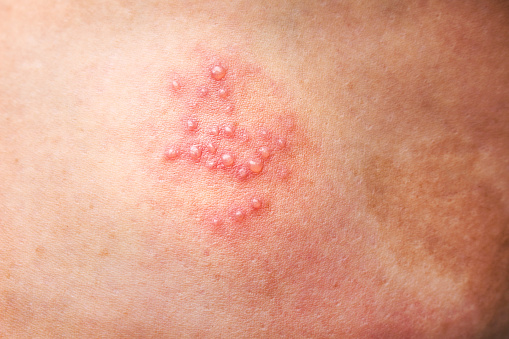 Mujer fondo de la piel de la pierna con erupción por herpes zóster o la enfermedad del herpes photo