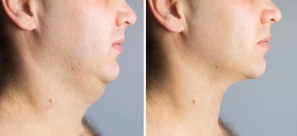 homme avant et après la procédure de correction de graisse de double menton - crane shot photos et images de collection