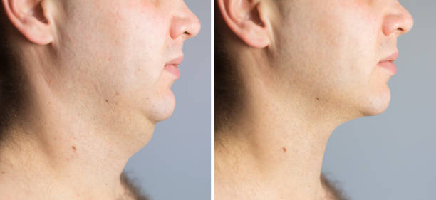 istock Man before and after double chin fat correction procedure 1151514016