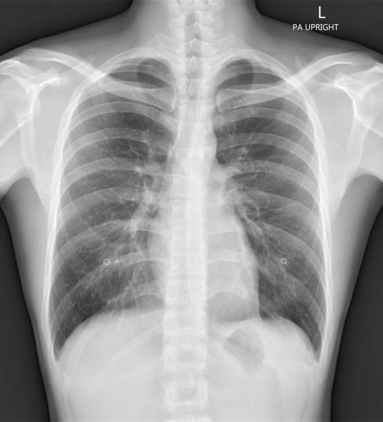 istock Normal film chest x-ray 1151563881