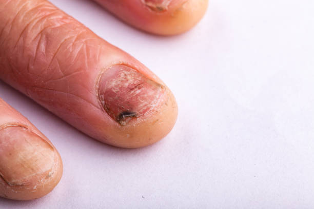 human finger with onychomycosis stock photo