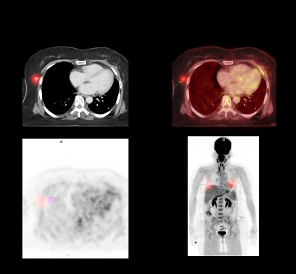 PET CT Scan image of whole body comparison Axial plane in CT scan and PET CT for detect cancer recurrence in patient lung cancer disease .