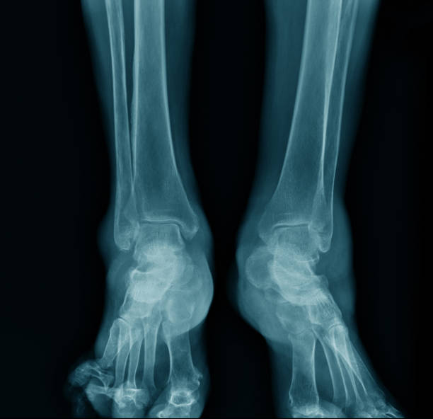 x-ray ankle AP view x-ray ankle AP view in blue tone roentgen stock pictures, royalty-free photos & images