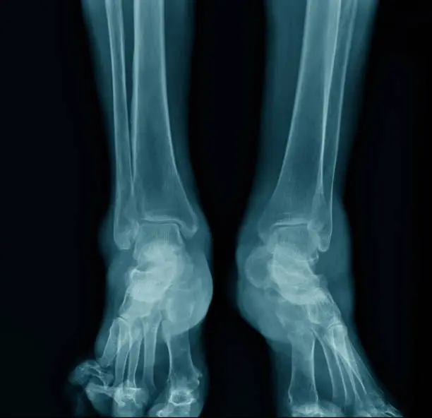 Photo of x-ray ankle AP view