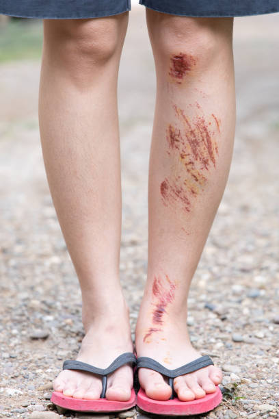 istock Bruise wound on woman's leg 1151818487