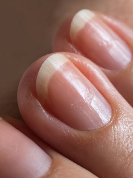 istock Damaged nails after gel polish. Close up. 1151860335