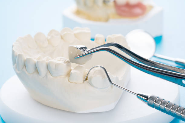 istock Close up implant and prosthodontic model. 1151916994