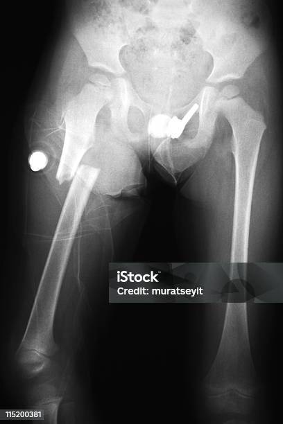 Złamana Noga Xxxl - zdjęcia stockowe i więcej obrazów Zdjęcie rentgenowskie - Zdjęcie rentgenowskie, Złamanie, Kość miedniczna