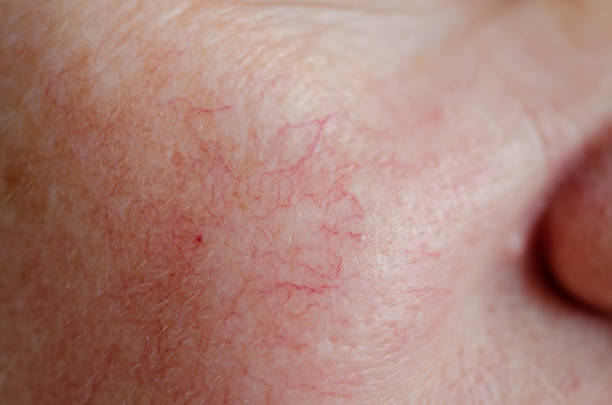 血管の問題と人間の顔の皮膚のクローズアップ - face close up ストックフォトと画像
