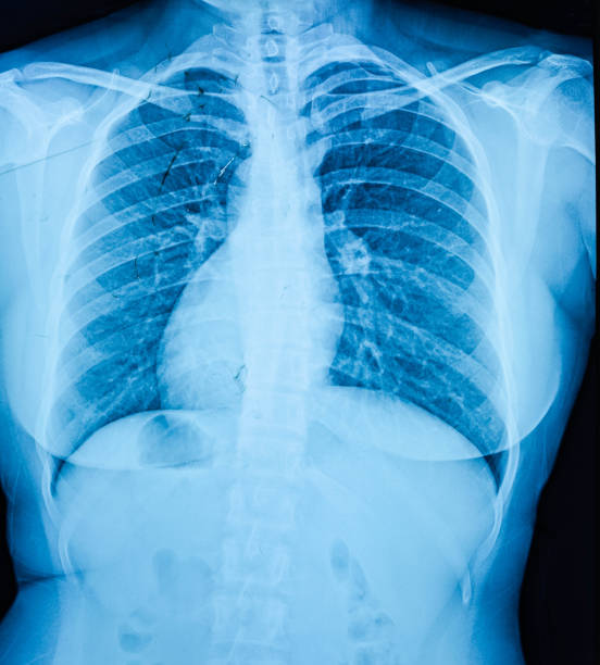 wnęka piersiowa film rentgenowski - x ray chest human lung rib cage zdjęcia i obrazy z banku zdjęć