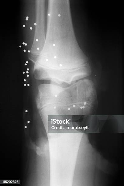 撮影したライフル Xxxl 膝から - 弾丸のストックフォトや画像を多数ご用意 - 弾丸, 骨折, X線撮影