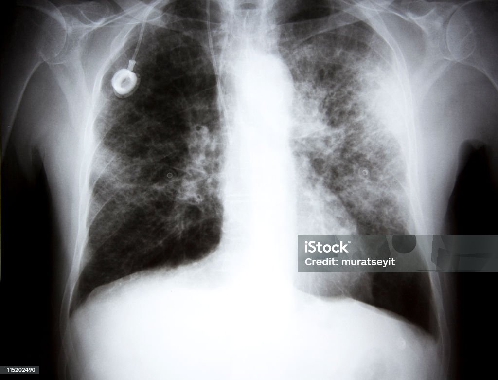 x-ray z przysiadu. raka XXL - Zbiór zdjęć royalty-free (Rak płuca)