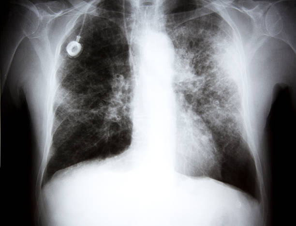x-ray z przysiadu. raka xxl - x ray chest human lung rib cage zdjęcia i obrazy z banku zdjęć