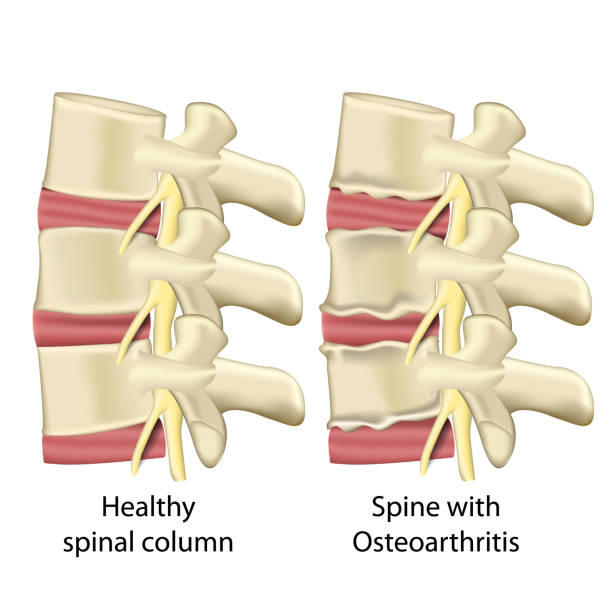 ilustrações, clipart, desenhos animados e ícones de espinha com osteoartrite, ilustração médica do vetor da coluna espinal isolada no fundo branco - human spine human vertebra disk spinal