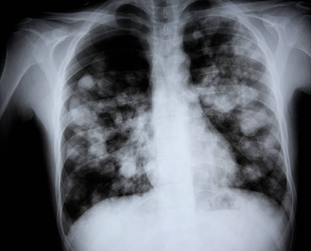 x-ray of a выпад подозреваемых h7n9 птичьего гриппа - x ray x ray image chest human lung стоковые фото и изображения