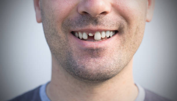 Male broken teeth damaged cracked front tooth need dentist to fix and repair stock photo